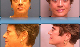 Face Lift/Neck Lift Case Study 3 - Before and After Result at Richmond Surgical Arts