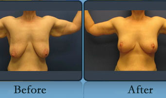 Brachioplasty Case Study 3 - Before and After Result at Richmond Surgical Arts