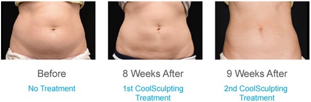 Coolsclupting Before and Aafter Treatment Photos