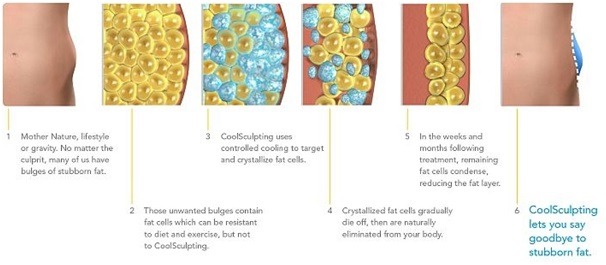 How does CoolSculpting work?
