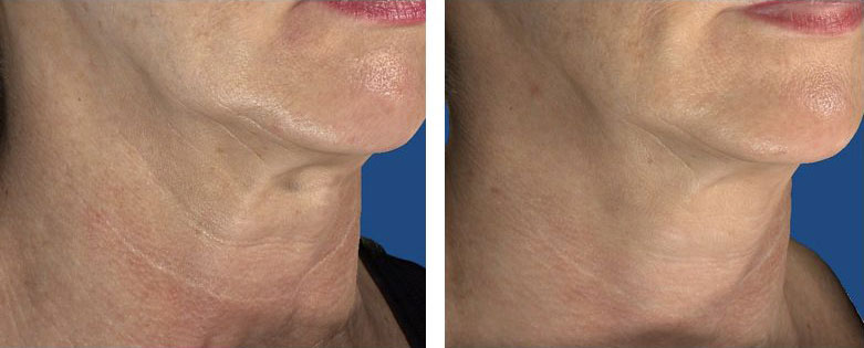 INTRAcel-171012-before-and-after