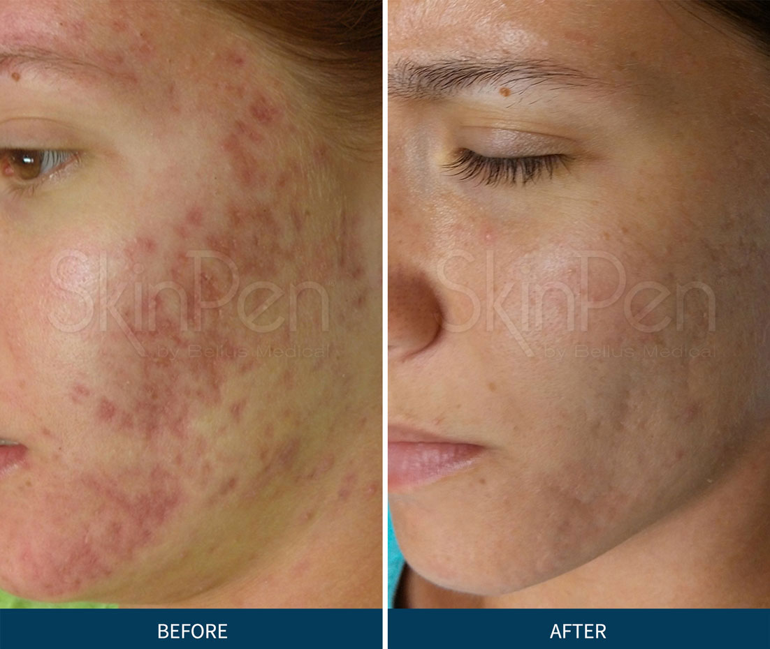 acne-scars-microneedling-v2