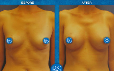 310cc Saline high profile implants No Breast Scar