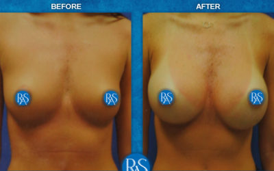 BREAST AUGMENTATION 330CC HP