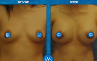 330cc Saline High Profile (Armpit Incision)