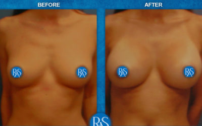 330 cc moderate plus saline implants