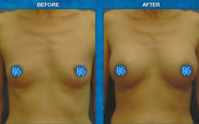 Arm pit incision Saline 330cc high profile