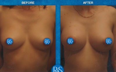 Before and 4 months after 330cc HP filled to 330cc