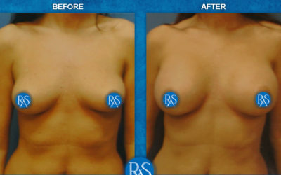 Moderate plus 390cc 3 month follow up