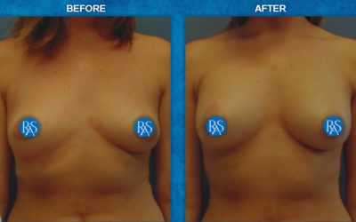 250cc moderate profile saline implants with armpit incision