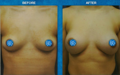 345-350cc HP saline 310cc implants