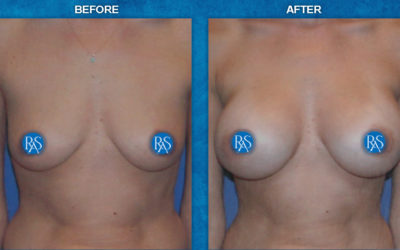 Before and 3 months after HP 380cc filled to 380cc