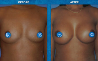 Before and 4 months after HP 330cc filled to 350cc
