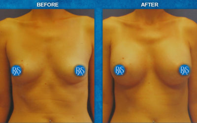 330cc Saline No breast scar augmentation HP