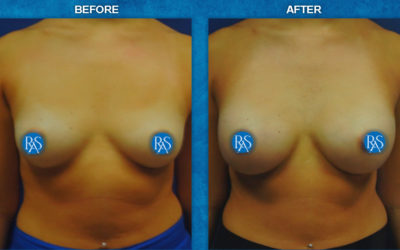 330CC HP Saline Axillary Incision