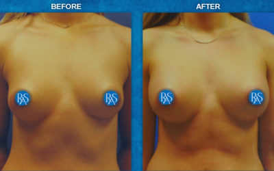 300cc and 340cc saline implants