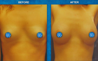 310cc HP saline Trans-Ax 3 months post op