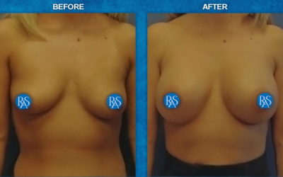 Trans-Axillary incision 350cc high profile saline implants