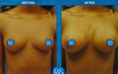 265cc Silicone implants