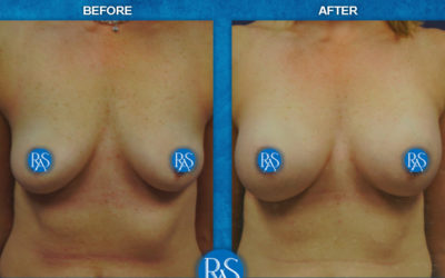 3 months after SSF 345cc
