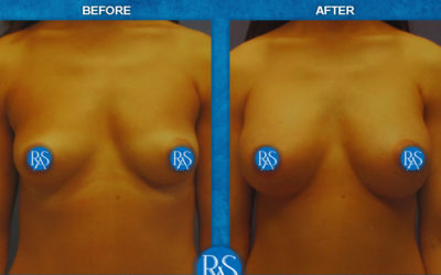 300cc silicone implants 3 months post procedure