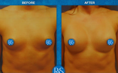310cc SRM Silicone implants