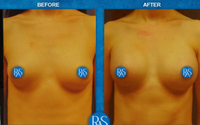 310cc right 275cc left silicone for asymetry improvement
