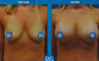 365 SSF gel implants