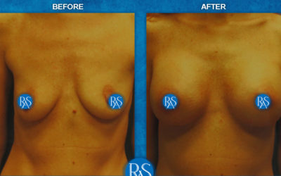 375cc moderate plus silicone implants