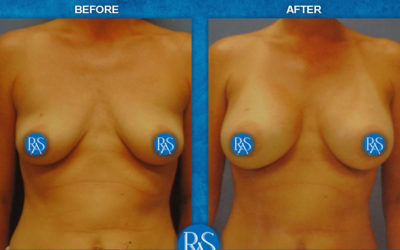 Before and 3 months after silicone breast implants