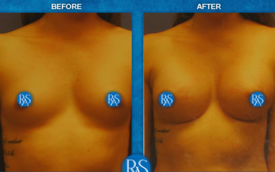 High profile saline 320cc and 340cc (arm pit incision)