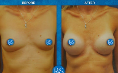 SSF 325cc 3 months PO