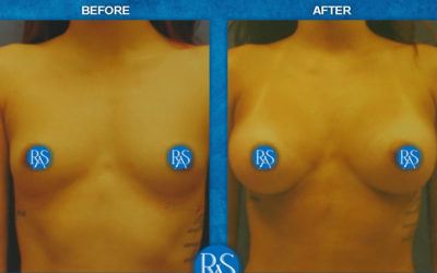 Breast augmentation saline 310cc high profile implants Arm pit incision