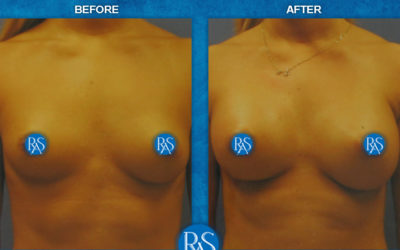 Saline 350cc mod plus armpit incision