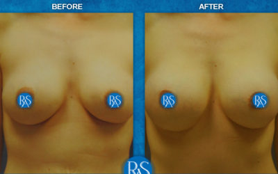 Saline to silicone exchange 420cc SRX