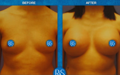 Silicone 475cc high profile