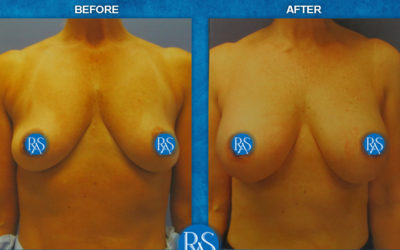 Silicone Dual Plane implants