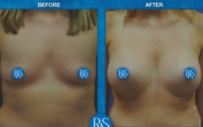 250cc SRM silicone implants 3 months PO