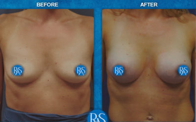 265cc and 295cc SSF gel implants