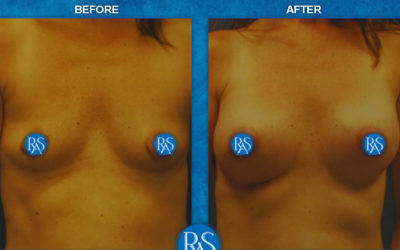 325cc high profile silicone periareolar lift on left