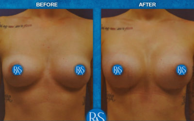 330 SRM silicone 1 week after surgery