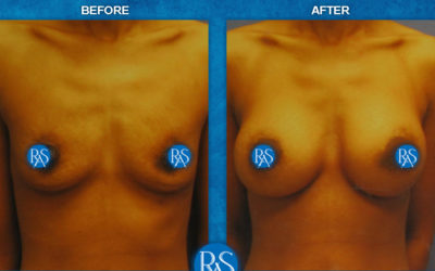 350cc saline high profile implants No Breast Scar