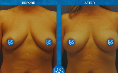 371cc moderate plus silicone implants