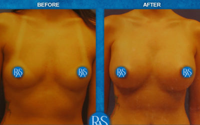 375cc MP silicone 3 months post op