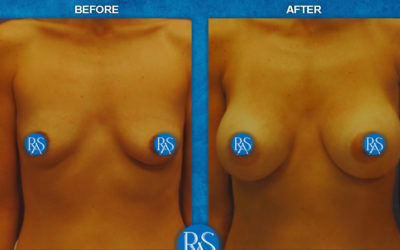425cc moderate plus silicone implants