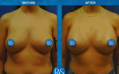 A few weeks after no breast scar 450cc saline implants