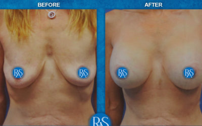 Dual plane SRF 325cc Silicone implants 2 months PO