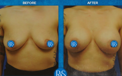 Dual plane SRM 425cc Silicone implants 2 months PO