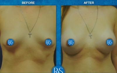 SSM 330cc Lowering fold to fit implant