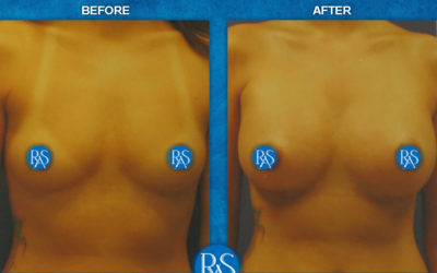 Silicone 375cc moderate plus
